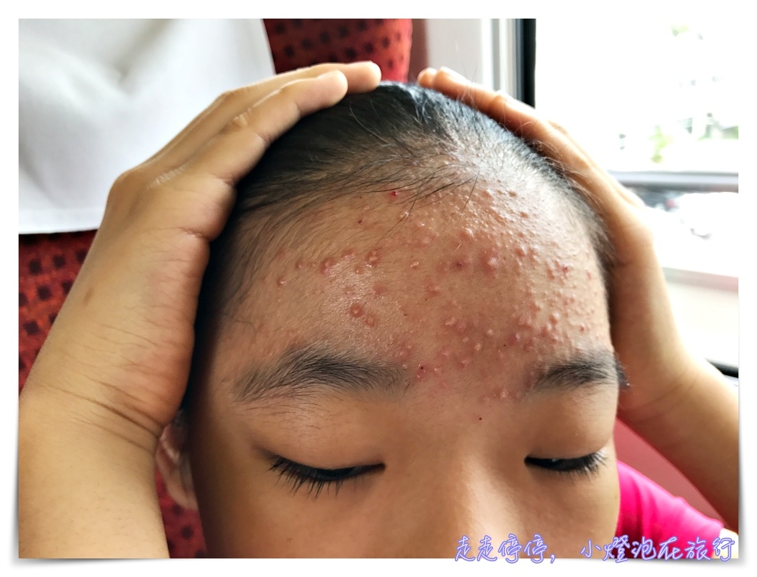 日本好用痘痘藥膏｜Acnes25，七天之後痘痘臉真的不一樣了～